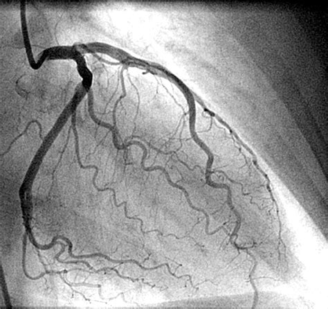 lv gram coronary angiogram|Coronary angiogram .